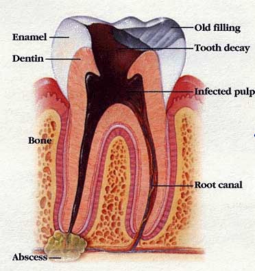 Root Canal